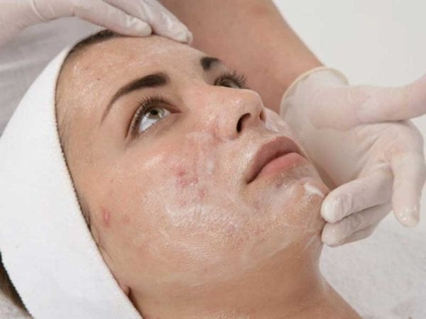 Chemical Face Peel Wellington - Skin Pigmentation Treatment