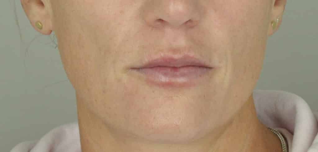 Directly after lip filler